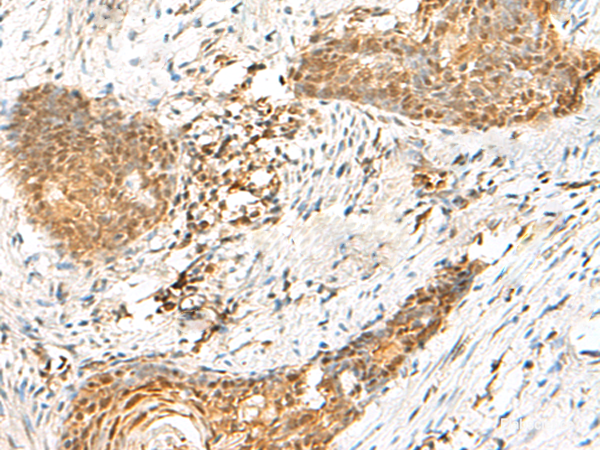Immunohistochemistry of paraffin-embedded Human esophagus cancer tissue using HMBOX1 Polyclonal Antibody at dilution of 1:60(×200)