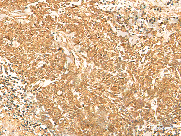 Immunohistochemistry of paraffin-embedded Human lung cancer tissue using KRT76 Polyclonal Antibody at dilution of 1:30(×200)