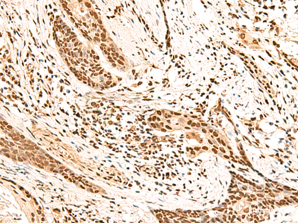 Immunohistochemistry of paraffin-embedded Human esophagus cancer tissue using HOXC13 Polyclonal Antibody at dilution of 1:60(×200)