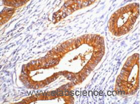 Immunohistochemistry of paraffin-embedded Human colon cancer tissue using CD66e Monoclonal Antibody at dilution of 1:200.