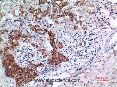 Immunohistochemistry of paraffin-embedded Human breast carcinoma tissue using Smad3 Monoclonal Antibody at dilution of 1:200.