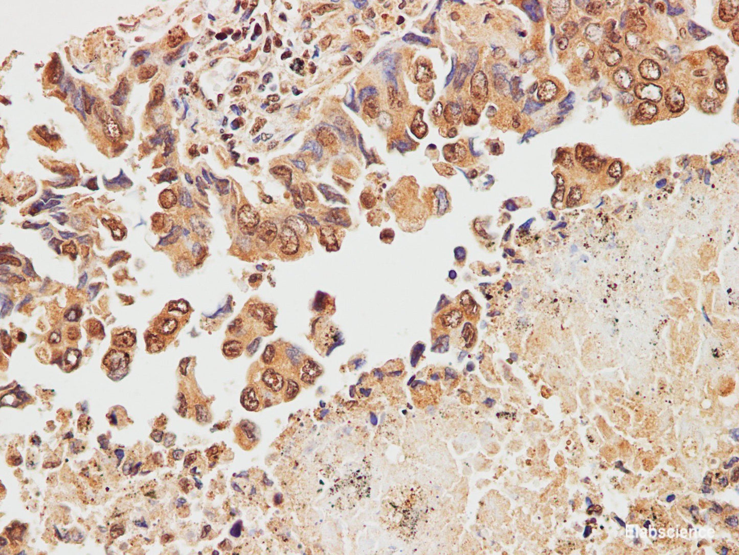 Immunohistochemistry of paraffin-embedded Human lung cancer using STOML2 Polyclonal Antibody at dilution of 1:200