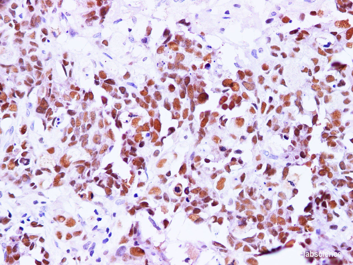Immunohistochemistry of paraffin-embedded Human breast cancer using BRCA1 Polyclonal Antibody at dilution of 1:100