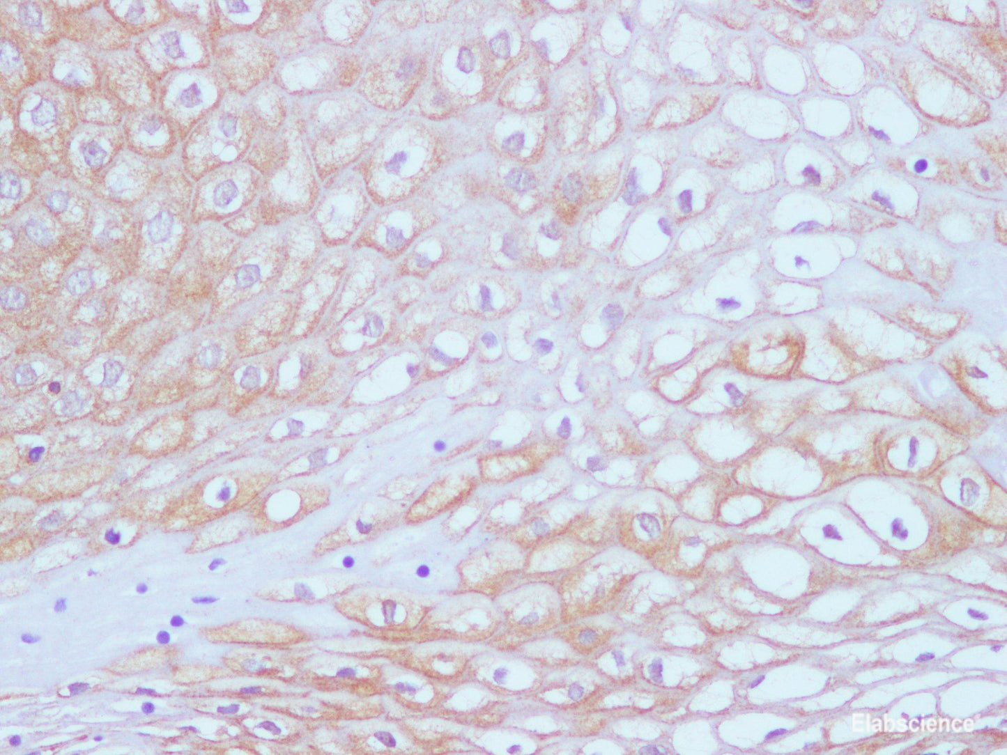 Immunohistochemistry of paraffin-embedded Human cervical cancer tissue using EGFR Polyclonal Antibody at dilution of 1:100