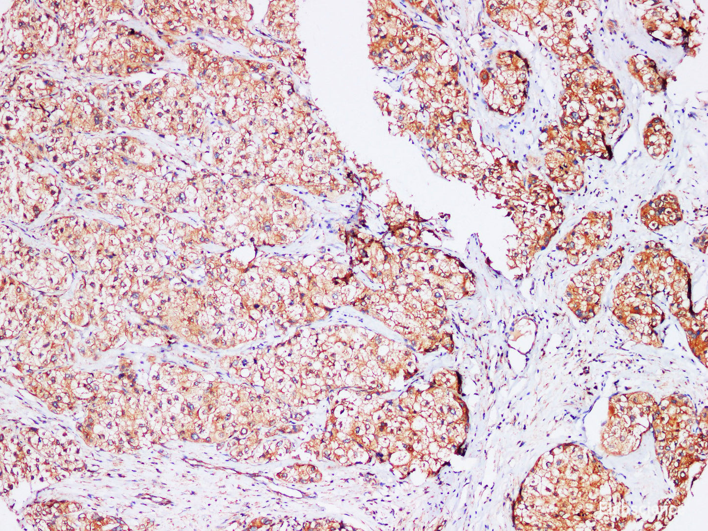 Immunohistochemistry of paraffin-embedded Human liver cancer using AFP Polyclonl Antibody at dilution of 1:200(100×).