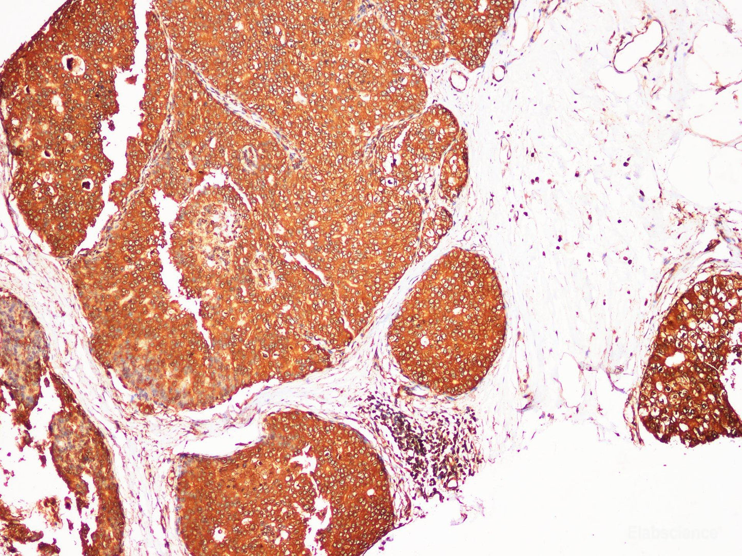 Immunohistochemistry of paraffin-embedded Human breast cancer using S100A9 Polyclonl Antibody at dilution of 1:200.
