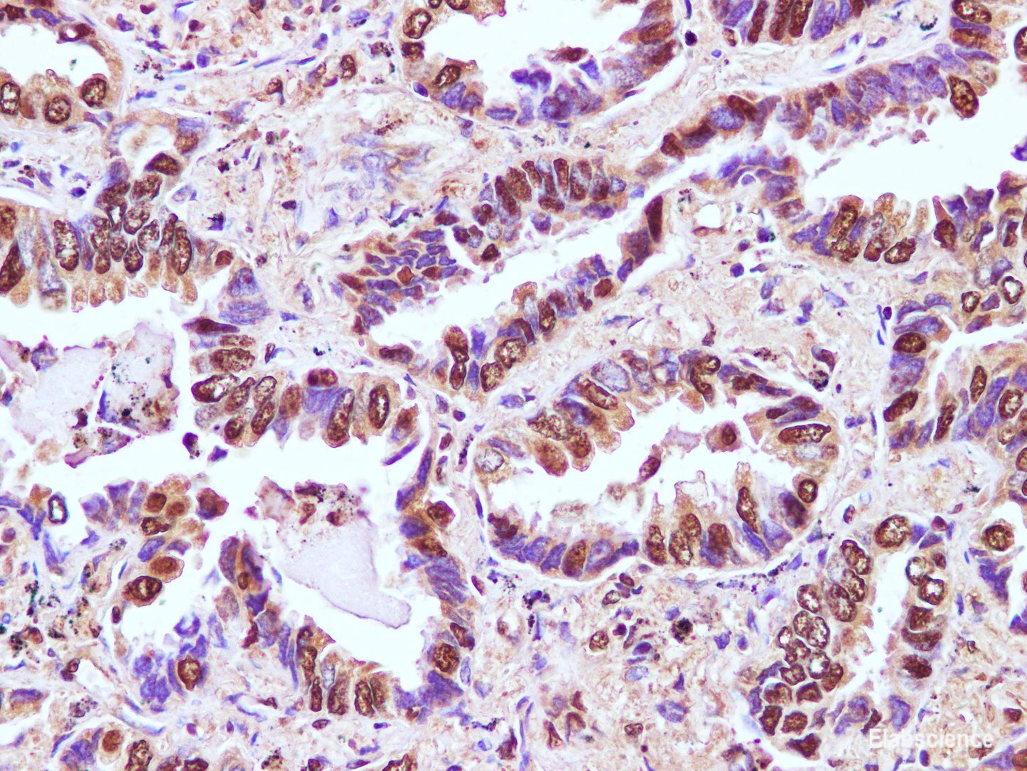 Immunohistochemistry of paraffin-embedded Human lung cancer using RBM3 Polyclonal Antibody at dilution of 1:100