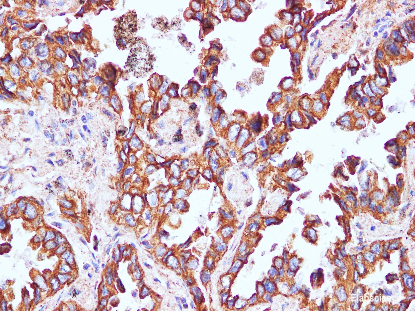 Immunohistochemistry of paraffin-embedded Human lung cancer using CK-8 Polyclonal Antibody at dilution of 1:100