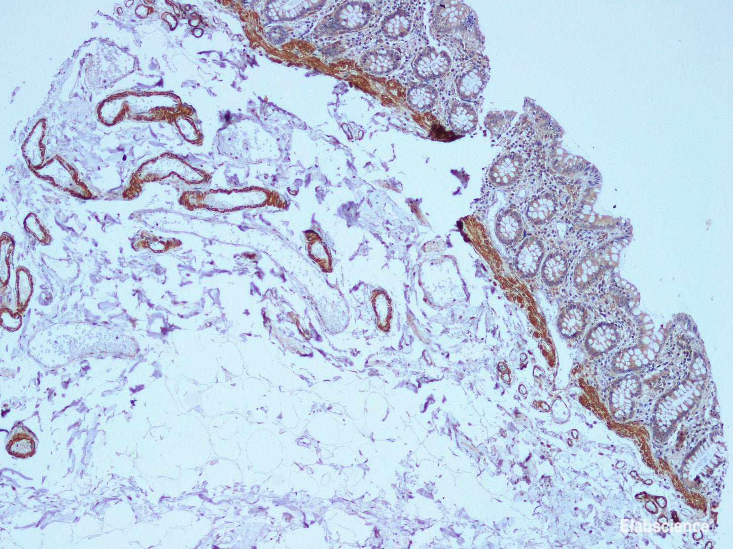 Immunohistochemistry of paraffin-embedded Human colon using COL1A1 Polyclonal Antibody at dilution of 1:100(100×)