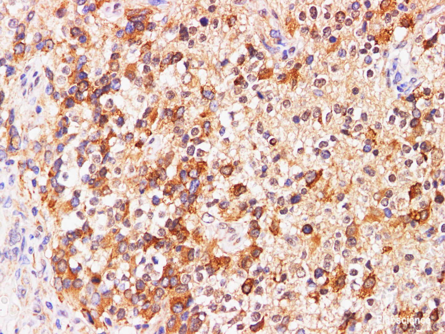 Immunohistochemistry of paraffin-embedded Human glioma using PRL Polyclonal Antibody at dilution of 1:200
