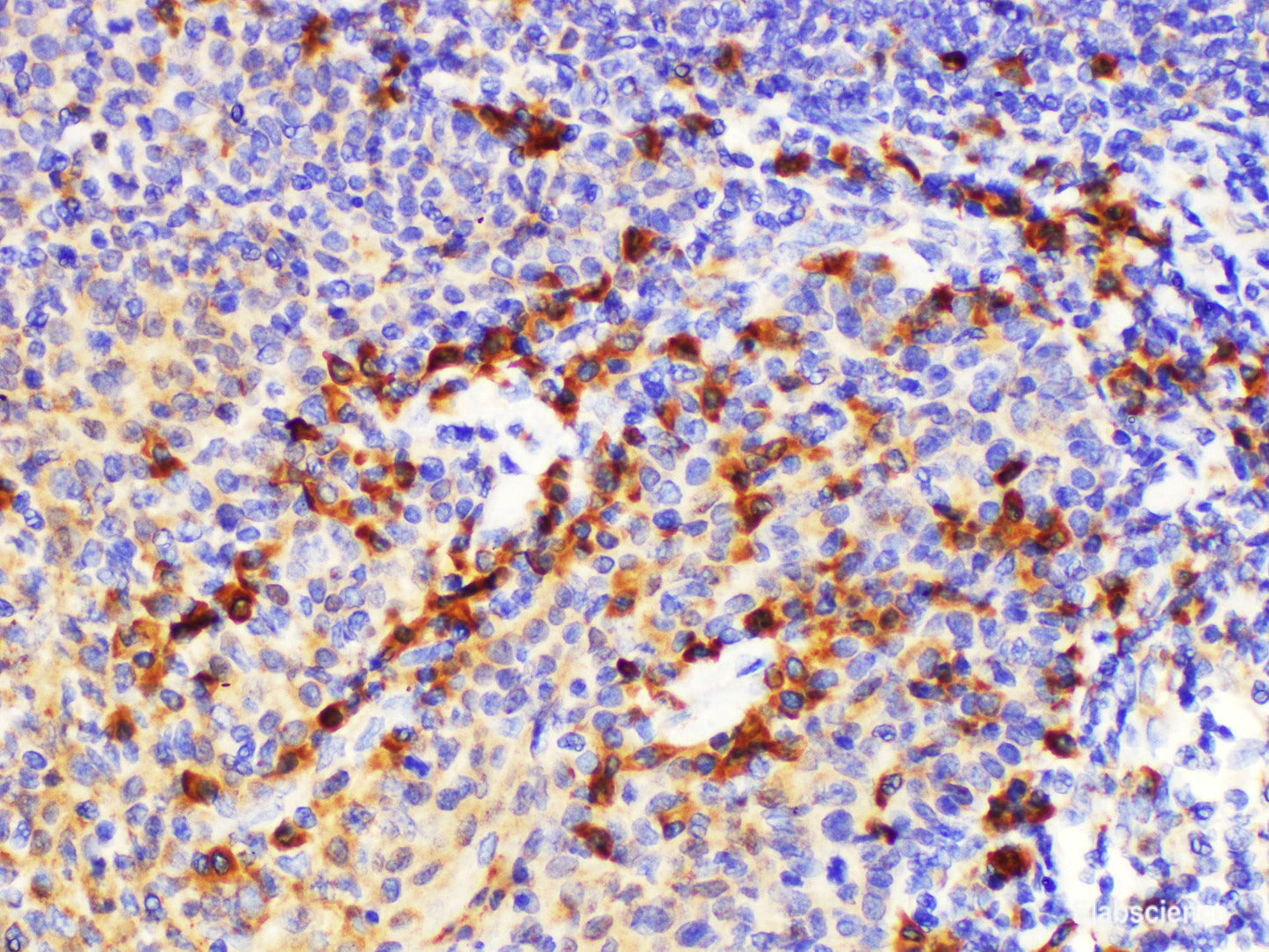 Immunohistochemistry of paraffin-embedded Human tonsil using S100a8 Polycloanl Antibody at dilution of 1:200