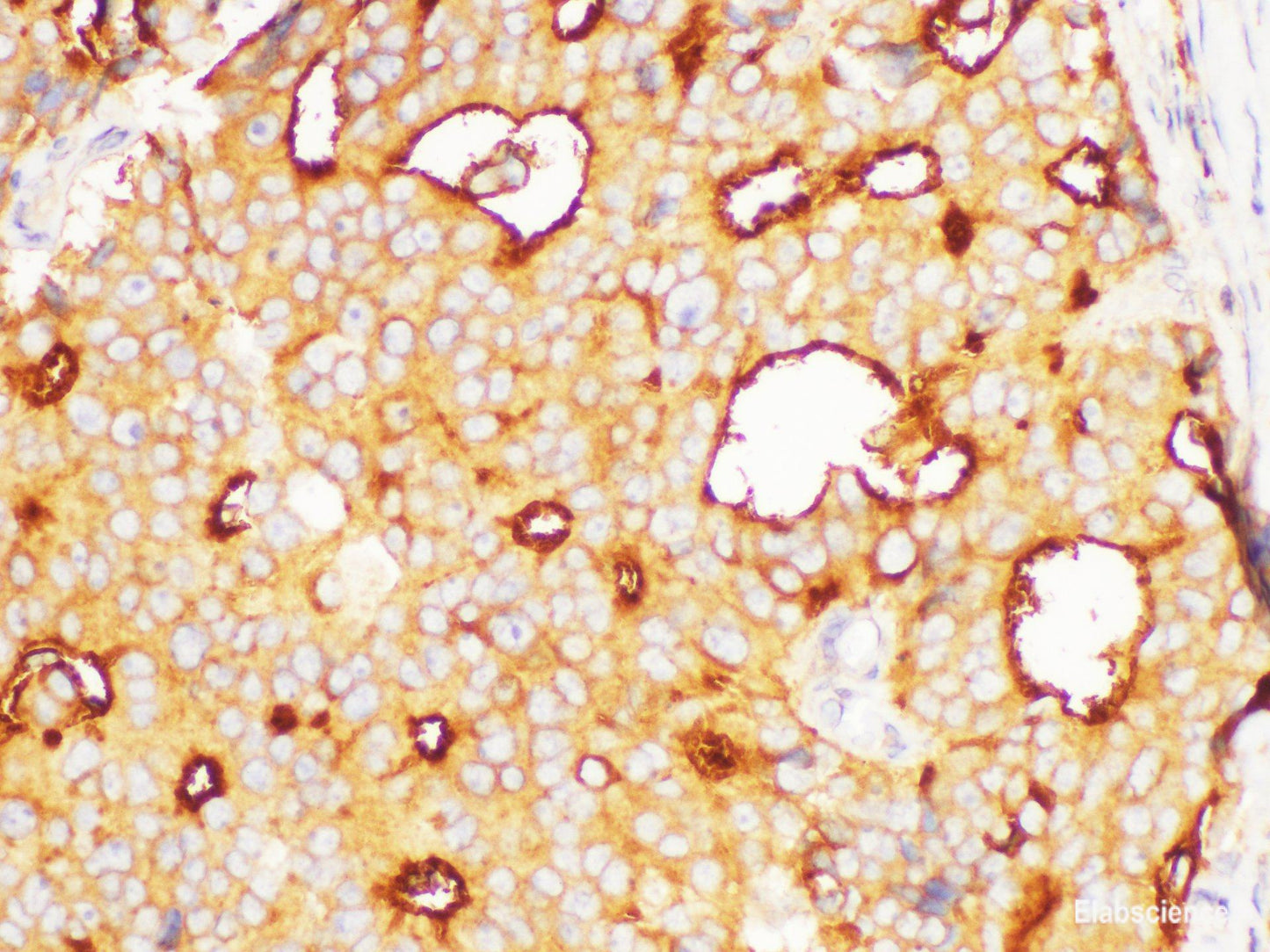 Immunohistochemistry of paraffin-embedded Human prostate cancer using FOLH1 Polycloanl Antibody at dilution of 1:200