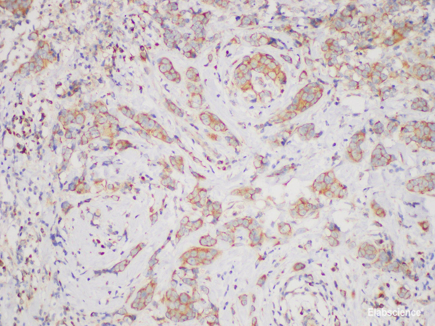 Immunohistochemistry of paraffin-embedded Human breast cancer using BCR Polycloanl Antibody at dilution of 1:200