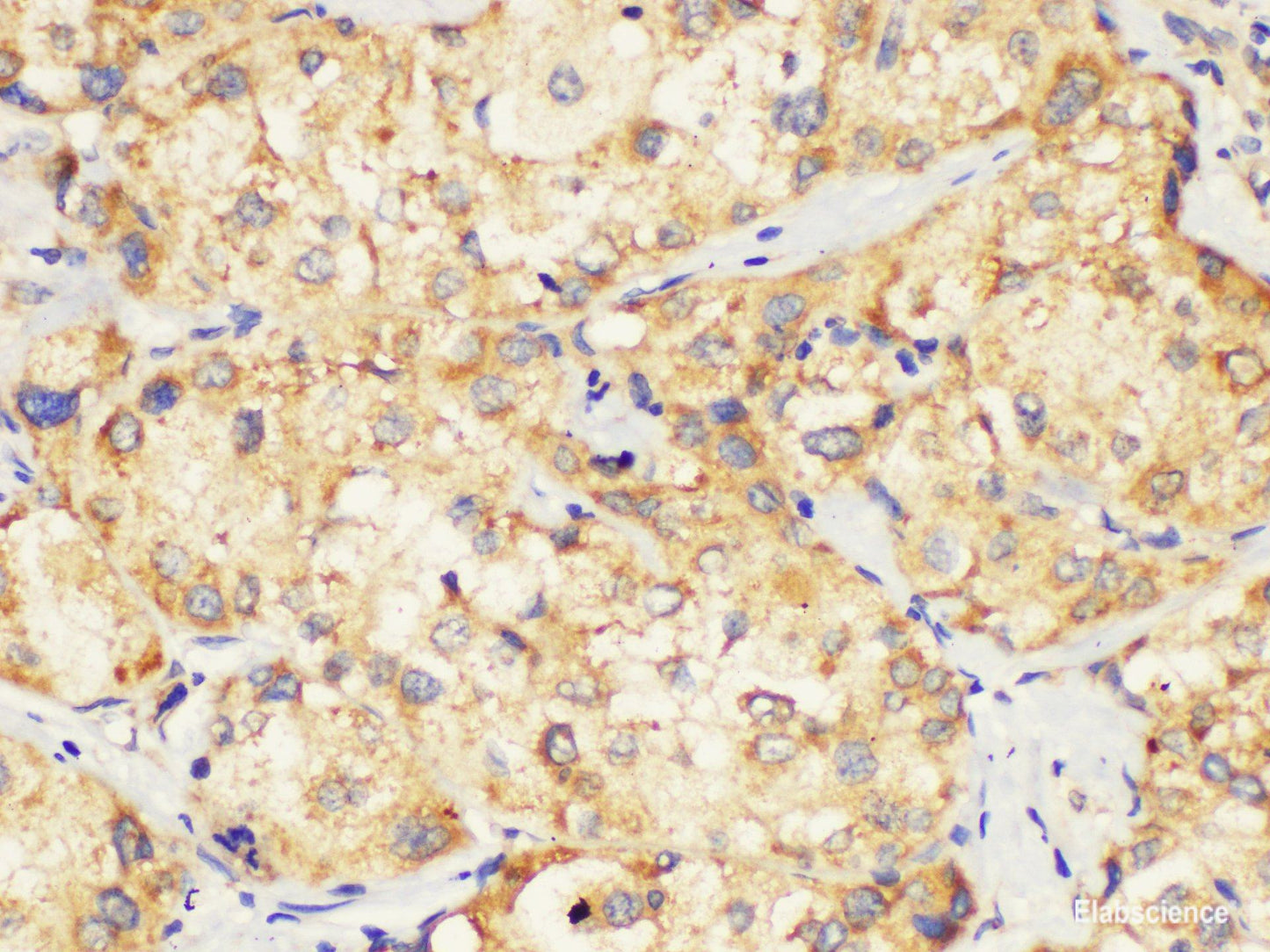 Immunohistochemistry of paraffin-embedded Human liver cancer using EIF2AK1 Polycloanl Antibody at dilution of 1:130