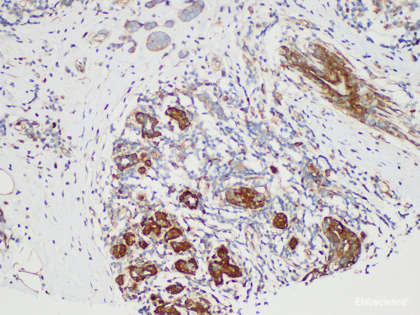 Immunohistochemistry of paraffin-embedded Human breast cancer using S100B Polycloanl Antibody at dilution of 1:50