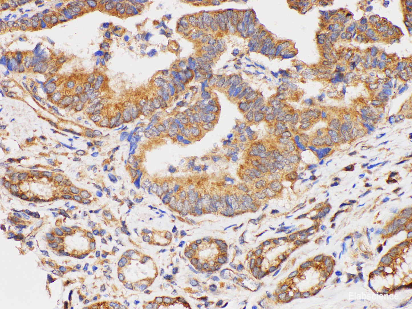 Immunohistochemistry of paraffin-embedded Human duodenal cancer using DMBT1 Polycloanl Antibody at dilution of 1:300