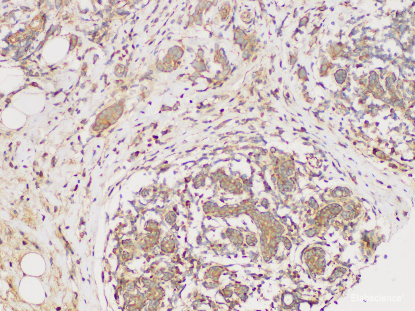 Immunohistochemistry of paraffin-embedded Human breast cancer using ECM1 Polycloanl Antibody at dilution of 1:300