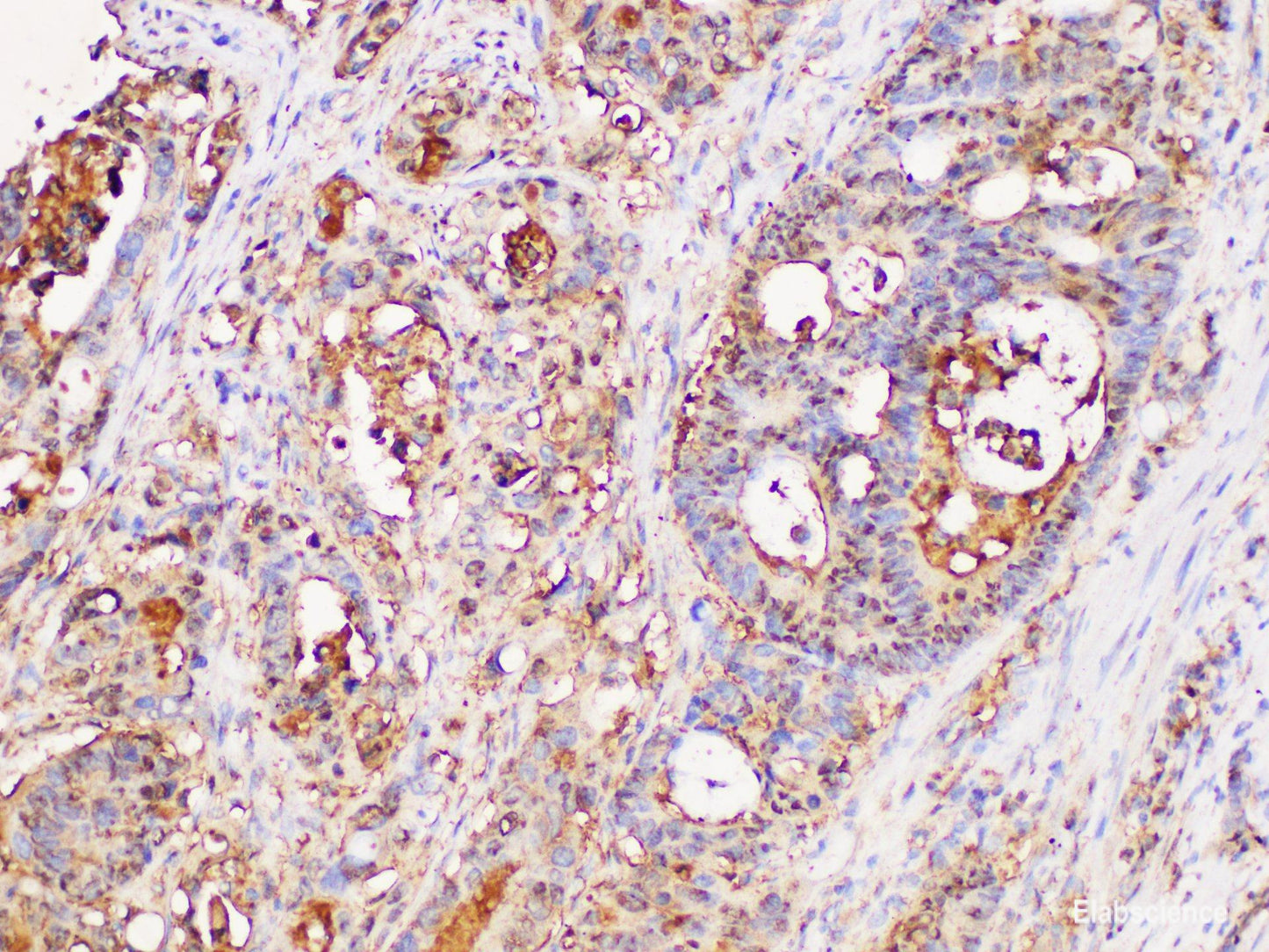 Immunohistochemistry of paraffin-embedded Human colon cancer using UBC Polycloanl Antibody at dilution of 1:100