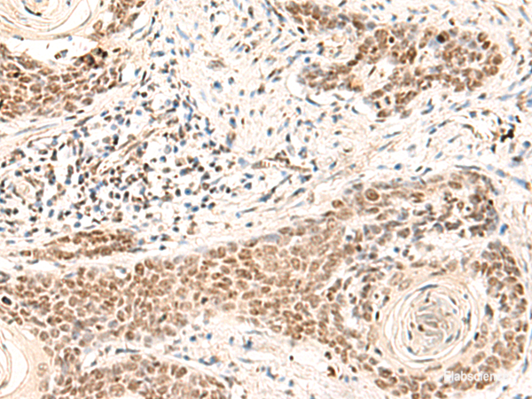 Immunohistochemistry of paraffin-embedded Human esophagus cancer tissue using HOXD9 Polyclonal Antibody at dilution of 1:30(×200)