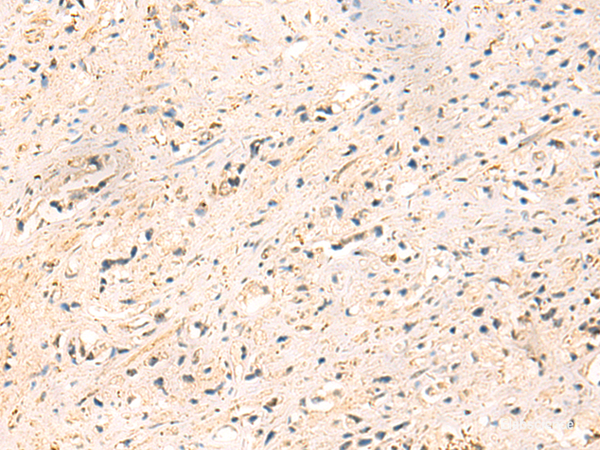 Immunohistochemistry of paraffin-embedded Human prost at e cancer tissue using IP6K3 Polyclonal Antibody at dilution of 1:50(×200)