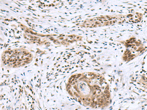 Immunohistochemistry of paraffin-embedded Human esophagus cancer tissue using INSM1 Polyclonal Antibody at dilution of 1:50(×200)