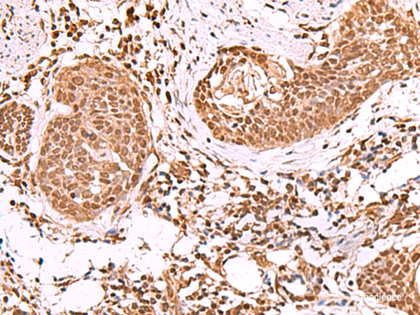 Immunohistochemistry of paraffin-embedded Human esophagus cancer tissue using IP6K1 Polyclonal Antibody at dilution of 1:55(×200)