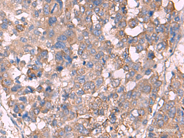 Immunohistochemistry of paraffin-embedded Human liver cancer tissue using KCNN3 Polyclonal Antibody at dilution of 1:60(×200)