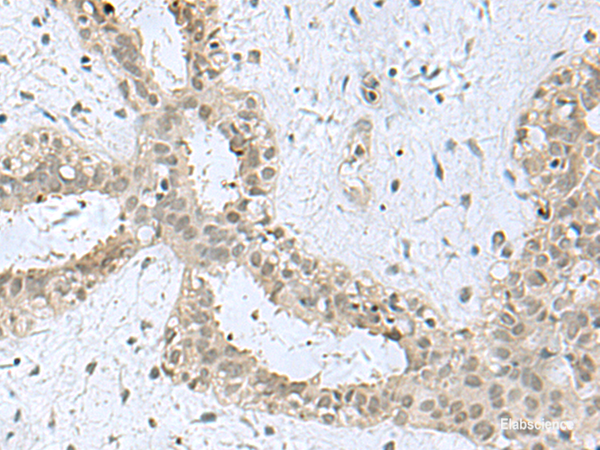 Immunohistochemistry of paraffin-embedded Human breast cancer tissue using KDM3B Polyclonal Antibody at dilution of 1:40(×200)