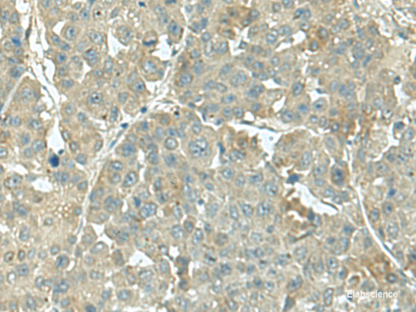 Immunohistochemistry of paraffin-embedded Human liver cancer tissue using KRT36 Polyclonal Antibody at dilution of 1:55(×200)