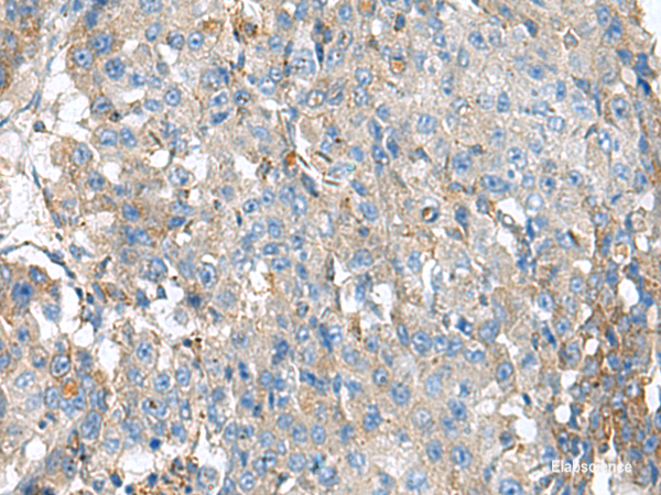 Immunohistochemistry of paraffin-embedded Human liver cancer tissue using KIAA0556 Polyclonal Antibody at dilution of 1:90(×200)