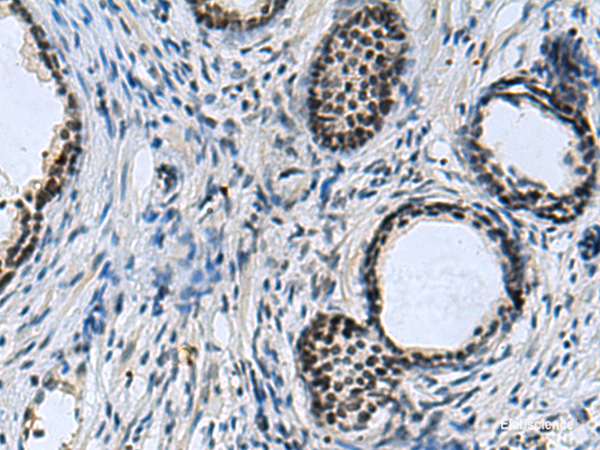 Immunohistochemistry of paraffin-embedded Human prost at e cancer tissue using CCAR2 Polyclonal Antibody at dilution of 1:40(×200)