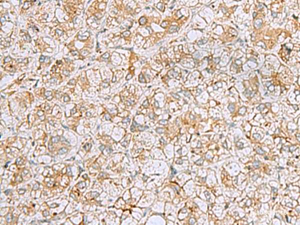 Immunohistochemistry of paraffin-embedded Human liver cancer tissue using FERMT1 Polyclonal Antibody at dilution of 1:30(×200)