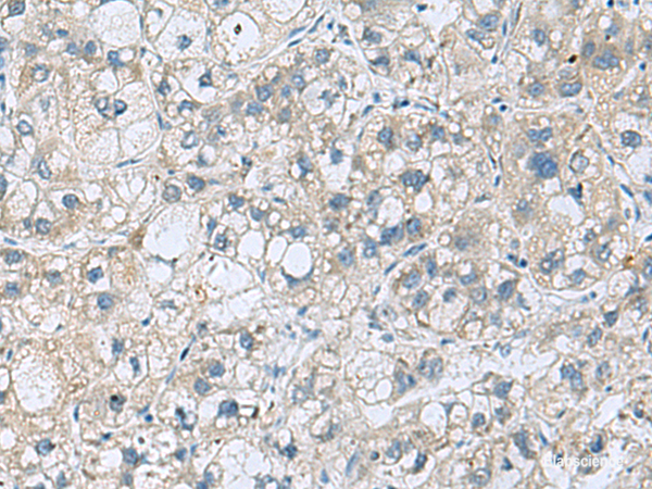 Immunohistochemistry of paraffin-embedded Human liver cancer tissue using KCNJ2 Polyclonal Antibody at dilution of 1:35(×200)