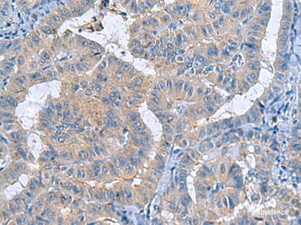 Immunohistochemistry of paraffin-embedded Human thyroid cancer tissue using RXFP4 Polyclonal Antibody at dilution of 1:40(×200)
