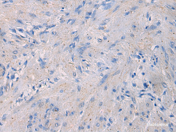 Immunohistochemistry of paraffin-embedded Human gastric cancer tissue using NFKB1 Polyclonal Antibody at dilution of 1:80(×200)