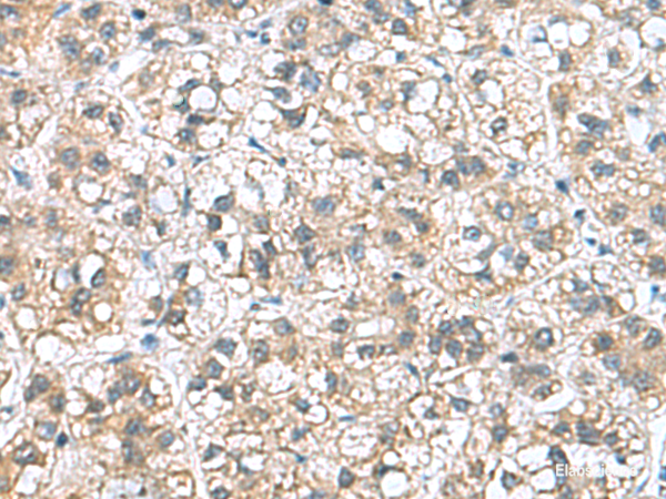 Immunohistochemistry of paraffin-embedded Human liver cancer tissue using NFKB1 Polyclonal Antibody at dilution of 1:50(×200)