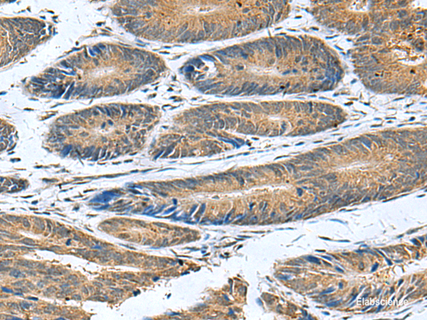 Immunohistochemistry of paraffin-embedded Human colorectal cancer tissue using CLEC1B Polyclonal Antibody at dilution of 1:55(×200)