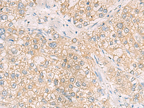Immunohistochemistry of paraffin-embedded Human liver cancer tissue using MAPK14 Polyclonal Antibody at dilution of 1:70(×200)