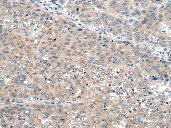 Immunohistochemistry of paraffin-embedded Human liver cancer tissue using SEMA4D Polyclonal Antibody at dilution of 1:60(×200)