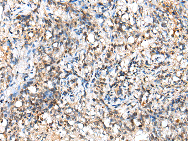 Immunohistochemistry of paraffin-embedded Human lung cancer tissue using NUDT18 Polyclonal Antibody at dilution of 1:40(×200)