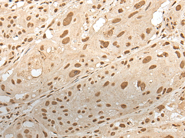 Immunohistochemistry of paraffin-embedded Human esophagus cancer tissue using ZNF274 Polyclonal Antibody at dilution of 1:35(×200)