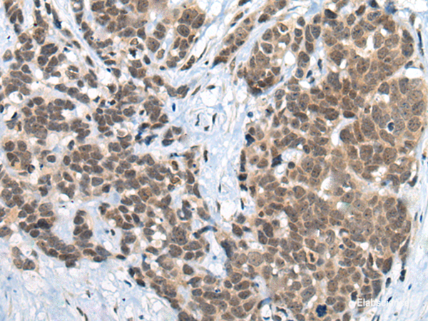 Immunohistochemistry of paraffin-embedded Human thyroid cancer tissue using ZNF83 Polyclonal Antibody at dilution of 1:50(×200)