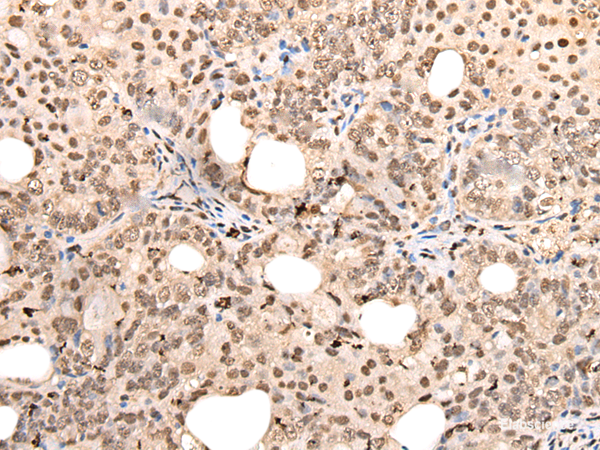 Immunohistochemistry of paraffin-embedded Human ovarian cancer tissue using ZSCAN12 Polyclonal Antibody at dilution of 1:40(×200)