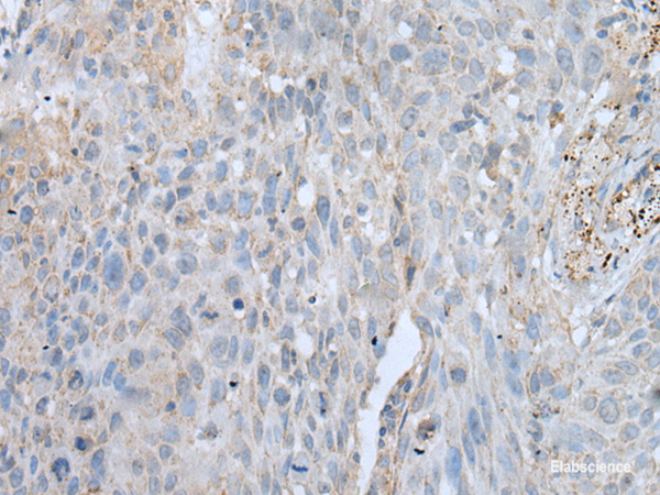 Immunohistochemistry of paraffin-embedded Human lung cancer tissue using VWA2 Polyclonal Antibody at dilution of 1:45(×200)