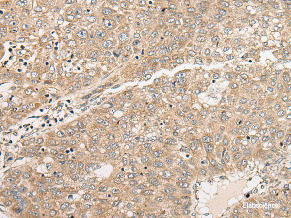Immunohistochemistry of paraffin-embedded Human liver cancer tissue using C1orf101 Polyclonal Antibody at dilution of 1:45(×200)