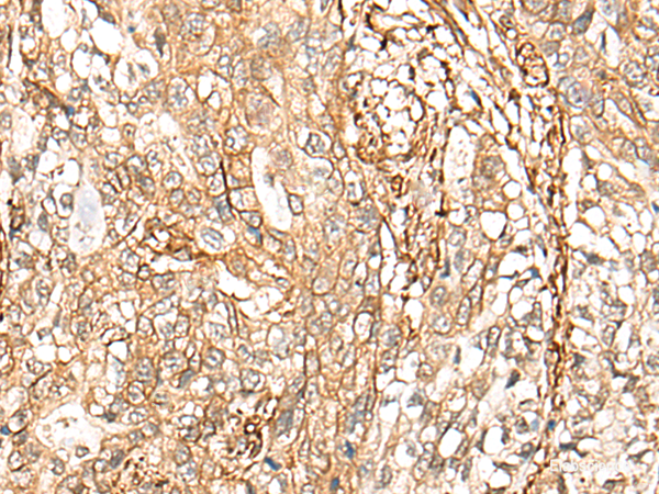 Immunohistochemistry of paraffin-embedded Human gastric cancer tissue using CD99 Polyclonal Antibody at dilution of 1:40(×200)