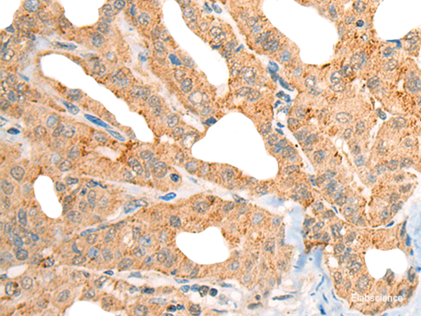Immunohistochemistry of paraffin-embedded Human thyroid cancer tissue using CECR1 Polyclonal Antibody at dilution of 1:40(×200)