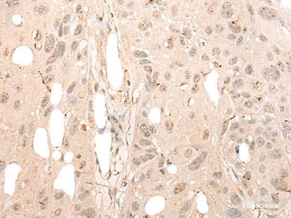 Immunohistochemistry of paraffin-embedded Human esophagus cancer tissue using DDX21 Polyclonal Antibody at dilution of 1:40(×200)