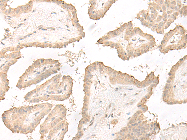Immunohistochemistry of paraffin-embedded Human thyroid cancer tissue using DCD Polyclonal Antibody at dilution of 1:35(×200)