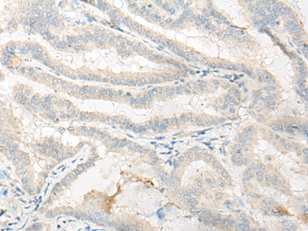 Immunohistochemistry of paraffin-embedded Human thyroid cancer tissue using DNASE1L1 Polyclonal Antibody at dilution of 1:25(×200)